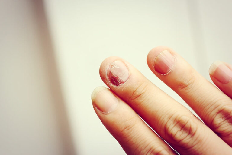 nail fungus from acrylic nails
