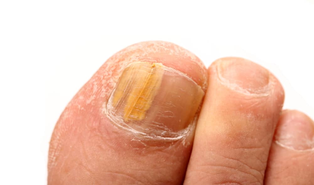 symptoms of toenail fungus toenail fungus symptoms