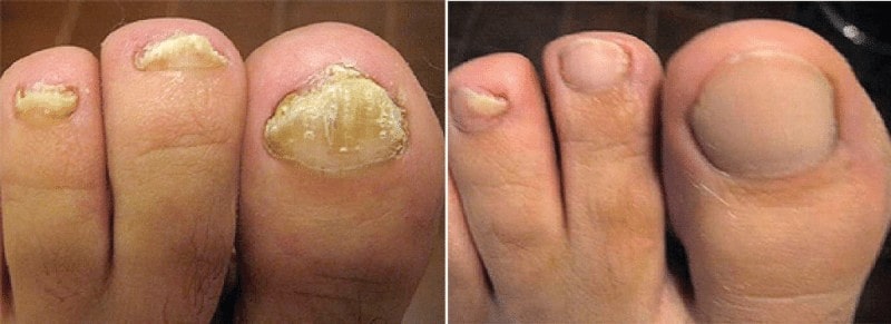 toenail fungus Before and after hydrogen peroxide hydrogen peroxide toenail fungus before and after