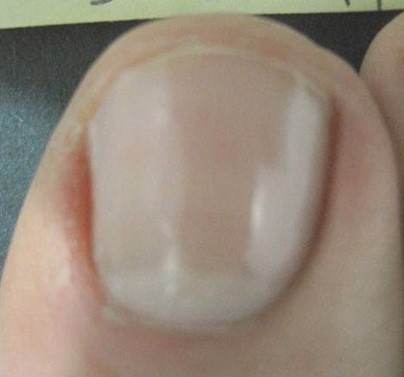 after Myco nuker for toenail fungus after Myco nuker for toenail fungus