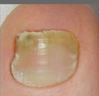 after using epsom salt for nail fungus after using epsom salt for toenail fungus