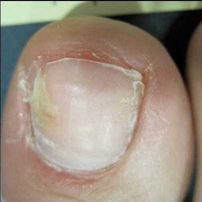 before Myco nuker for toenail fungus before organic fungus Myco nuker for toenail fungus