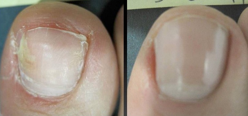 before and after Myco nuker for toenail fungus before and after Myco nuker for toenail fungus
