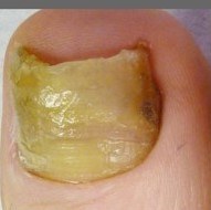 before epsom salt to treat nail fungus before epsom salt to treat nail fungus
