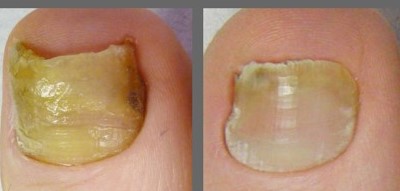 epsom salt for nail fungus before and after epsom salt for toenail fungus before and after