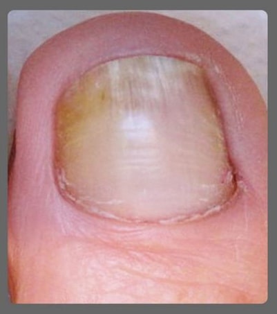 after kerasal nail treatment pic after kerasal nail treatment pic