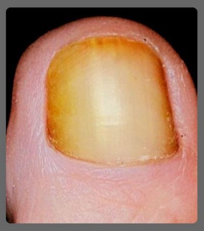 before kerasal nail treatment pic before kerasal nail treatment pic