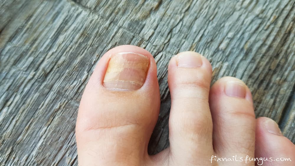 what is the most effective treatment for toenail fungus what is the most effective treatment for toenail fungus